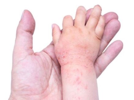 Immagine relativa al post intitolato PEDIATRIA: Qual è il legame tra allergie stagionali e dermatite? 